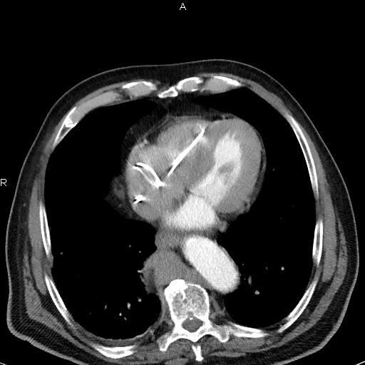 File:Azygos continuation of the inferior vena cava (Radiopaedia 18537-18404 C+ arterial phase 40).jpg