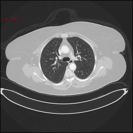 Azygos fissure and lobe (Radiopaedia 47620-52278 Axial lung window 33).jpg
