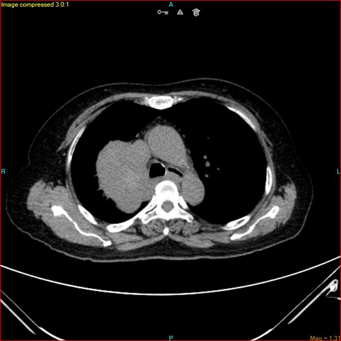 Azygos vein aneurysm (Radiopaedia 77824-90130 A 22).jpg