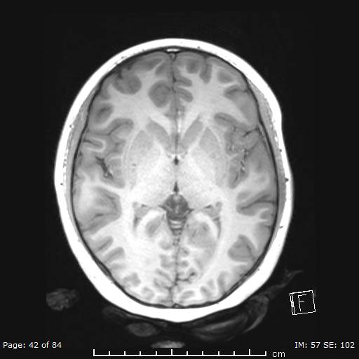 File:Balo concentric sclerosis (Radiopaedia 61637-69636 Axial T1 42).jpg