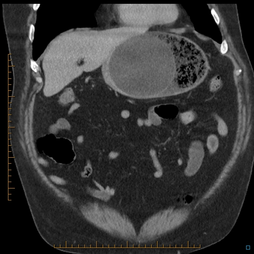 File:Bariatric balloon causing gastric outlet obstruction (Radiopaedia 54449-60672 B 15).jpg