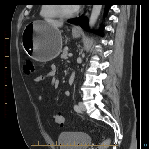 File:Bariatric balloon causing gastric outlet obstruction (Radiopaedia 54449-60672 C 37).jpg