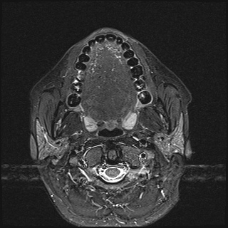 File:Basal cell carcinoma - nasal region (Radiopaedia 70292-80365 Axial STIR 22).jpg
