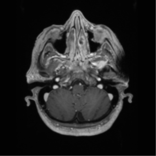 Basal ganglia metastasis (Radiopaedia 78928-91828 Axial T1 C+ 12).png