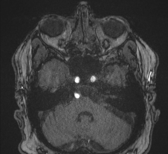 Basilar artery dissection (Radiopaedia 77032-88976 Axial TOF 48).jpg