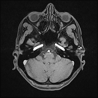 Basilar artery perforator aneurysm (Radiopaedia 82455-97733 Axial T1 fat sat 30).jpg