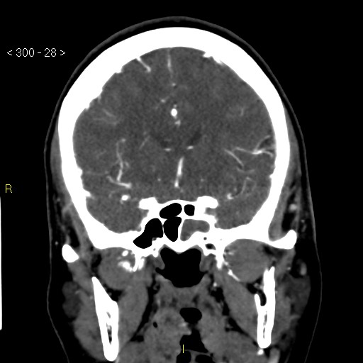 Basilar artery thrombosis (Radiopaedia 16260-15944 B 19).jpg