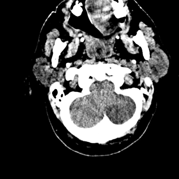 Basilar artery thrombosis (Radiopaedia 53351-59352 Axial non-contrast 18).jpg