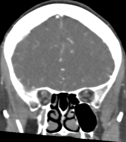 File:Basilar tip aneurysm with coiling (Radiopaedia 53912-60086 B 40).jpg