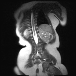 File:Beckwith-Wiedeman syndrome with bilateral Wilms tumors (Radiopaedia 60850-69233 B 4).jpg