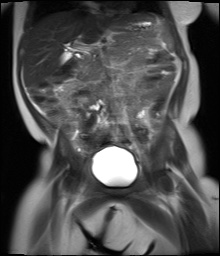 File:Beckwith-Wiedeman syndrome with bilateral Wilms tumors (Radiopaedia 60850-69233 Coronal T2 9).jpg