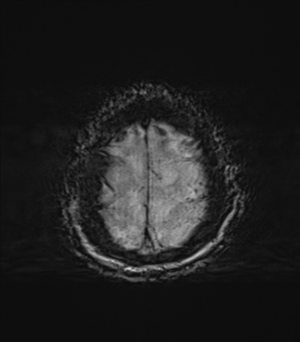 File:Behavioral variant frontotemporal dementia and late onset schizophrenia (Radiopaedia 52197-58083 Axial SWI 73).png