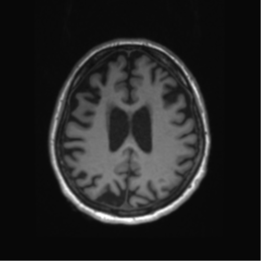 Behavioral variant frontotemporal dementia and late onset schizophrenia (Radiopaedia 52197-58083 Axial T1 29).png