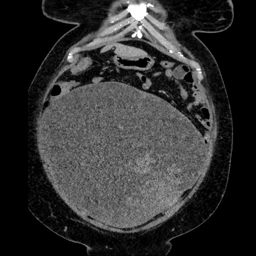 Benign leiomyoma with hydropic features (Radiopaedia 89250-106130 B 39).jpg