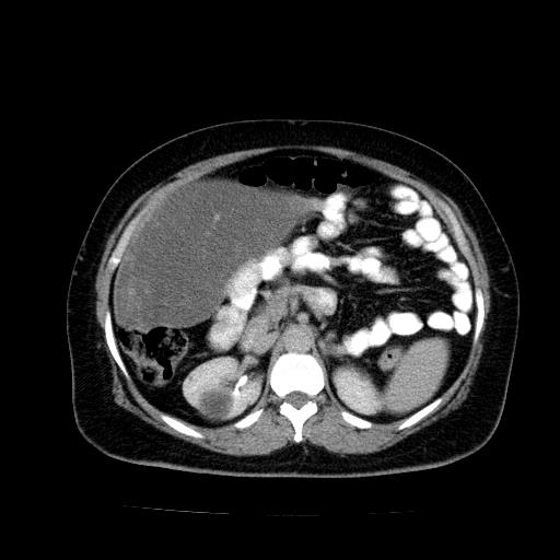 Benign spindle cell tumor - abdominopelvic (Radiopaedia 61300-69212 Axial C+ delayed 22).jpg