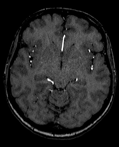 Berry aneurysm of the terminal internal carotid artery (Radiopaedia 88286-104918 Axial TOF 115).jpg