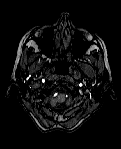 Berry aneurysm of the terminal internal carotid artery (Radiopaedia 88286-104918 Axial TOF 41).jpg