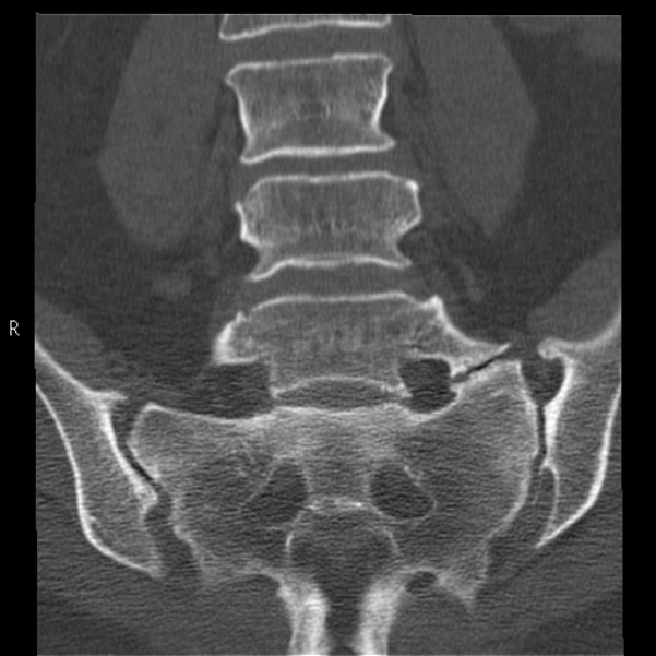 Bertolotti syndrome (Radiopaedia 24864-25128 Coronal bone window 25).jpg
