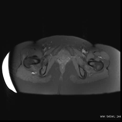 File:Bicornuate uterus- on MRI (Radiopaedia 49206-54297 Axial T1 fat sat 18).jpg