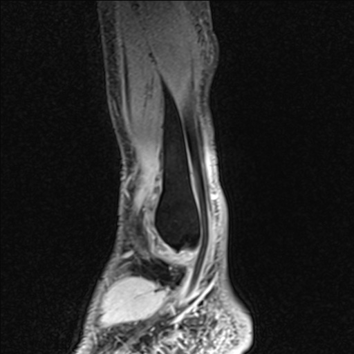 File:Bilateral Achilles tendon complete tear (Radiopaedia 81344-95051 Sagittal WE - Left 95).jpg