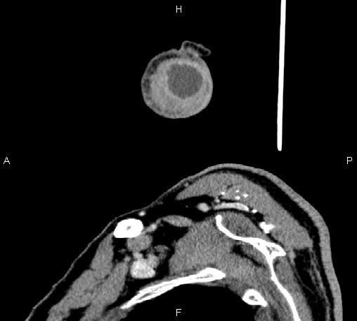 Bilateral Warthin tumors (Radiopaedia 84034-99263 D 11).jpg