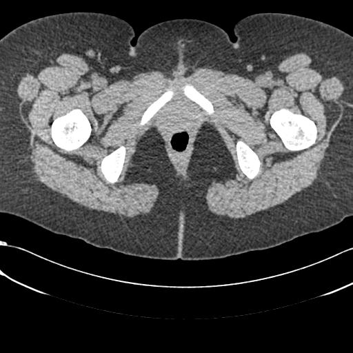 File:Bilateral acetabular protrusion with pincer type femoro-acetabular impingement (Radiopaedia 30134-30733 AXIAL SOFT THIN 88).jpg
