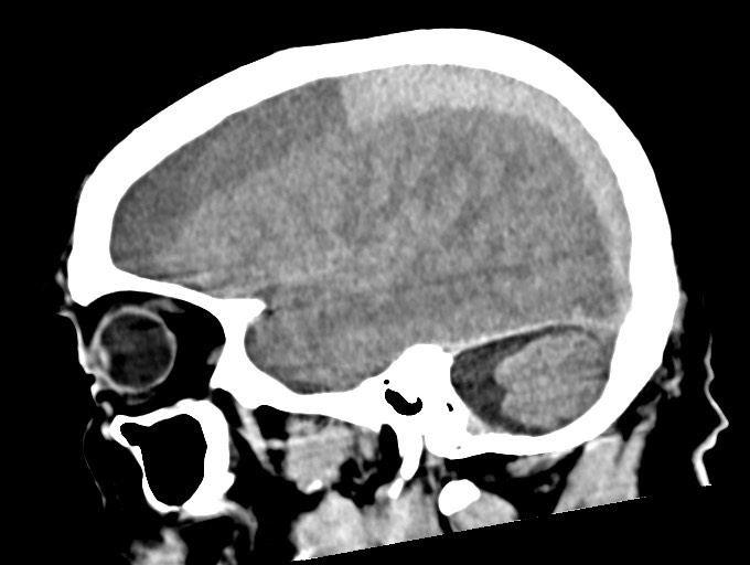 Bilateral acute on chronic subdural hematomas (Radiopaedia 78466-91146 C 42).jpg