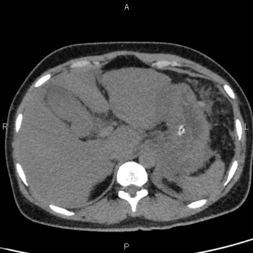 File:Bilateral adrenal gland hyperenhancement in pancreatitis (Radiopaedia 86642-102753 Axial non-contrast 22).jpg