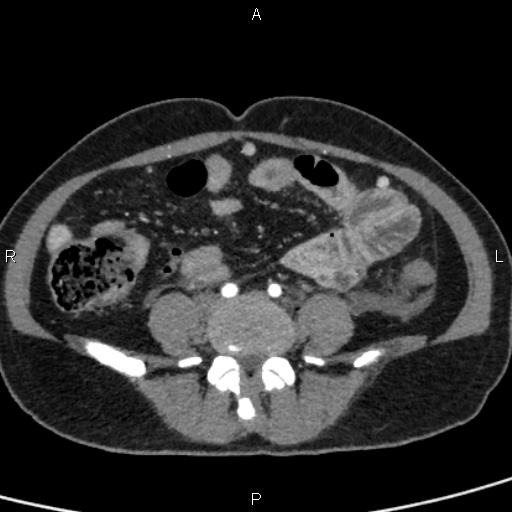 Bilateral adrenal gland hyperenhancement in pancreatitis (Radiopaedia 86642-102753 B 89).jpg