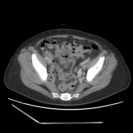 Bilateral adrenal granulocytic sarcomas (chloromas) (Radiopaedia 78375-91007 A 97).jpg