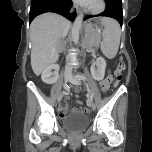 Bilateral adrenal granulocytic sarcomas (chloromas) (Radiopaedia 78375-91007 B 52).jpg