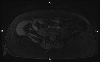 Bilateral adrenal myelolipoma (Radiopaedia 63058-71537 Axial T1 C+ fat sat 80).jpg