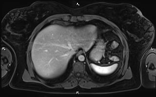 Bilateral adrenal myelolipoma (Radiopaedia 63058-71537 G 16).jpg