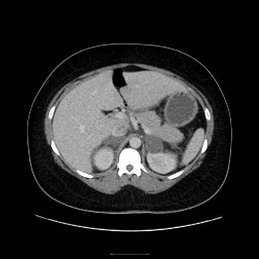 Bilateral adrenal thrombosis (Radiopaedia 58182-65256 A 19).jpg