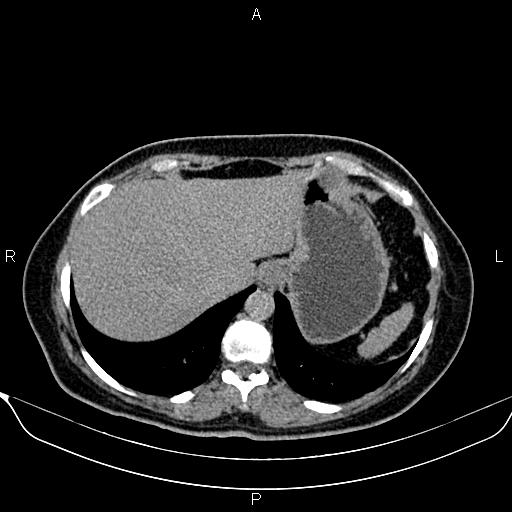 File:Bilateral benign adrenal adenomas (Radiopaedia 86912-103124 Axial C+ delayed 7).jpg