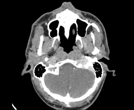 Bilateral carotid body tumors (Radiopaedia 61841-69870 Axial Post contrast 10).jpg