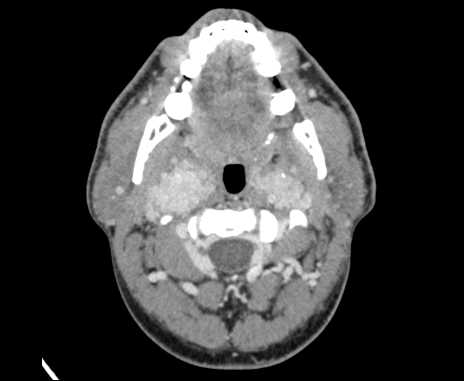 File:Bilateral carotid body tumors (Radiopaedia 61841-69870 Axial Post contrast 27).jpg