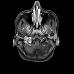 File:Bilateral carotid body tumors and right jugular paraganglioma (Radiopaedia 20024-20060 Axial 108).jpg