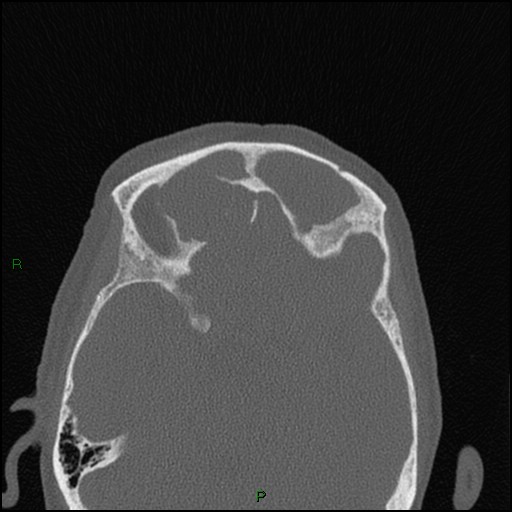 Bilateral frontal mucoceles (Radiopaedia 82352-96454 Axial bone window 110).jpg