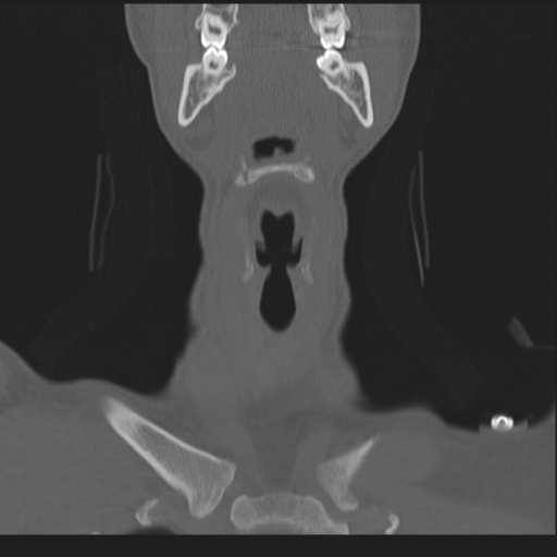 File:Bilateral locked facets (Radiopaedia 33850-35016 Coronal bone window 15).png