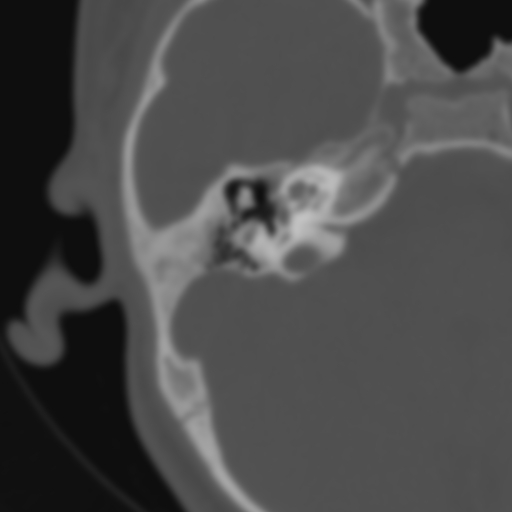 Bilateral otosclerosis (Radiopaedia 57237-64157 B 57).jpg