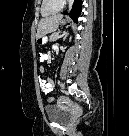 Bilateral ovarian dermoid cysts (Radiopaedia 85785-101603 D 55).jpg