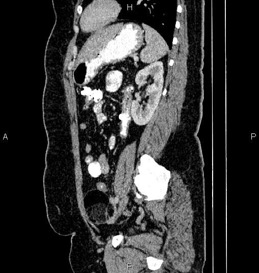 Bilateral ovarian dermoid cysts (Radiopaedia 85785-101603 D 66).jpg