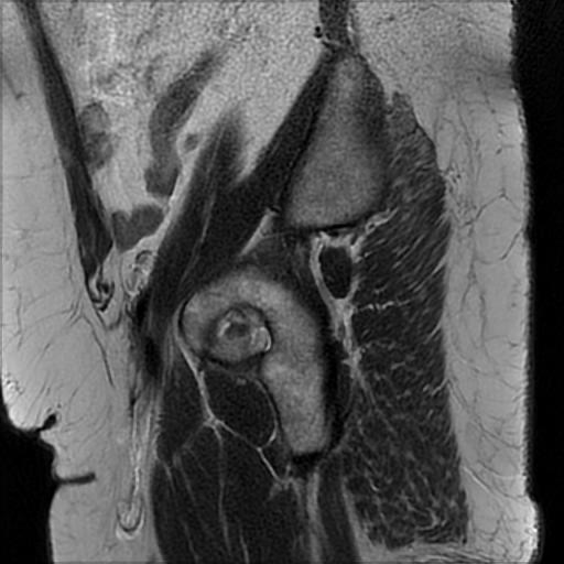 File:Bilateral ovarian dermoid cysts (Radiopaedia 90152-107338 Sagittal T2 2).jpg