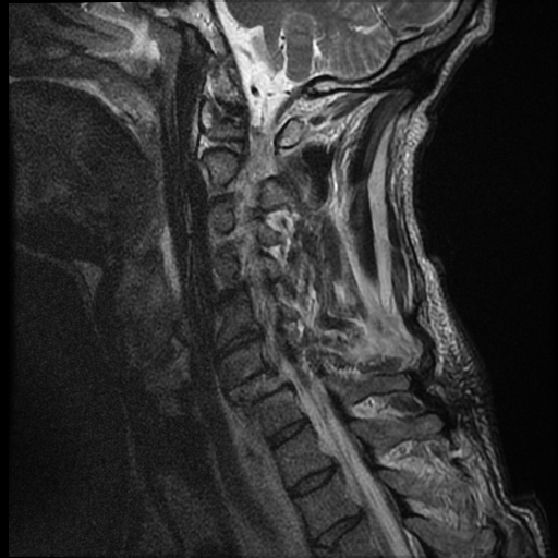 File:Bilateral perched facets with cord injury (Radiopaedia 45587-49714 Sagittal T2 5).jpg