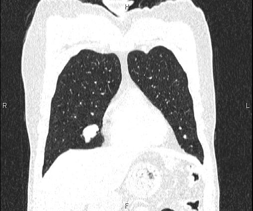 Bilateral pulmonary AVM (Radiopaedia 83134-97505 Coronal lung window 25).jpg