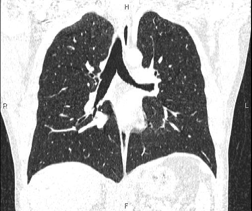 Bilateral pulmonary AVM (Radiopaedia 83134-97505 Coronal lung window 47).jpg