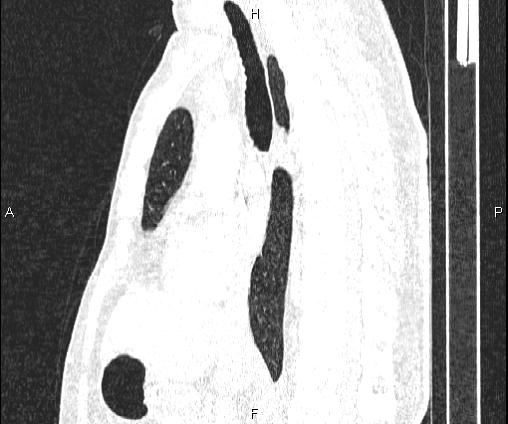 Bilateral pulmonary AVM (Radiopaedia 83134-97505 Sagittal lung window 58).jpg