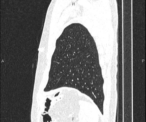 Bilateral pulmonary AVM (Radiopaedia 83134-97505 Sagittal lung window 97).jpg