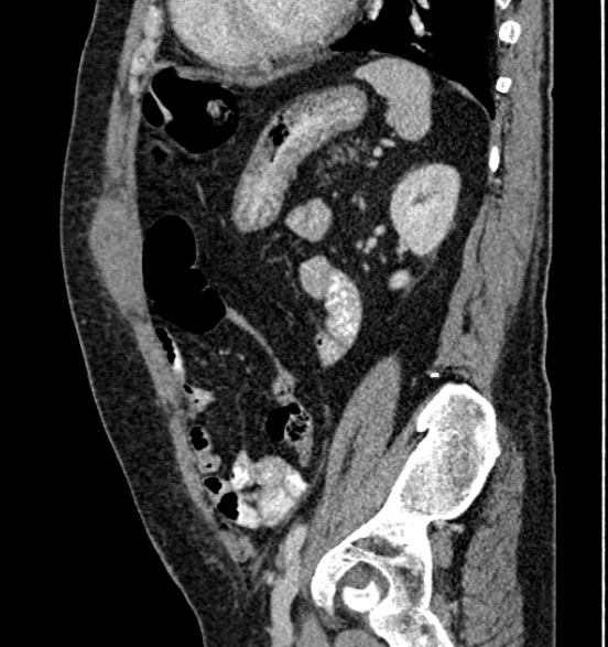 File:Bilateral rectus sheath hematomas (Radiopaedia 50778-56252 B 56).jpg